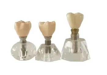 A Ciência médica dente modelo de cristal Transparente implante modelos Removível implante frete grátis